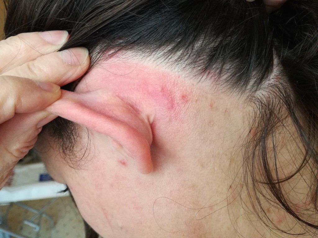 Pikkelysömör fejbőr kezelése ausztrália post