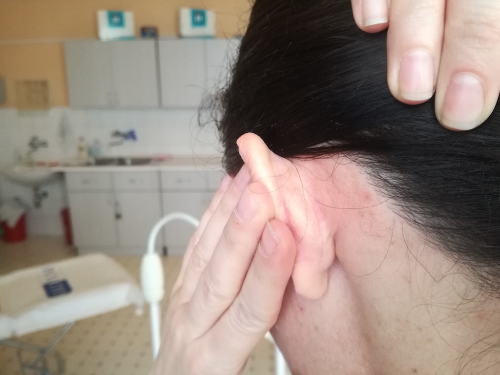 A pikkelysömör kezelés a fülekben