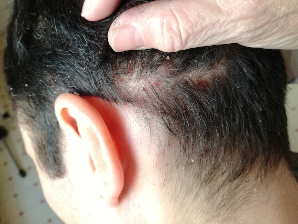 A pikkelysömör tünetei - Modern fejbőr psoriasis kezelése